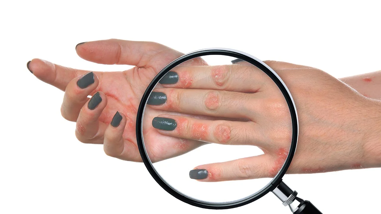 Learning About Psoriasis