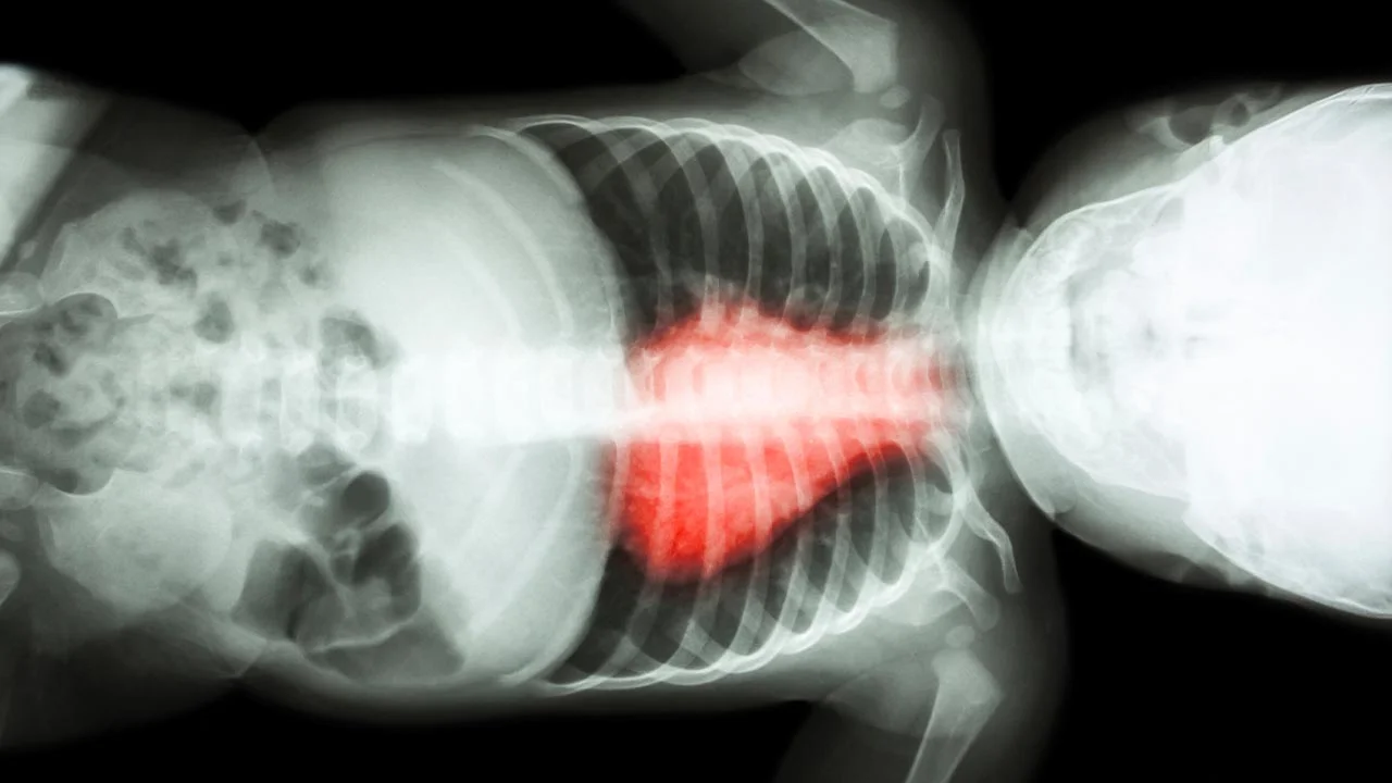 What is rheumatic fever?