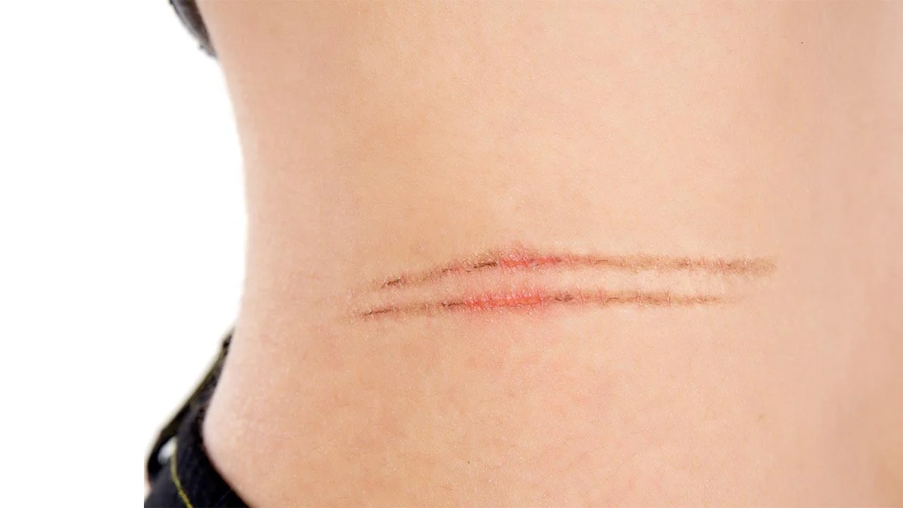 Are You a Victim of Painful Scar Tissue? 