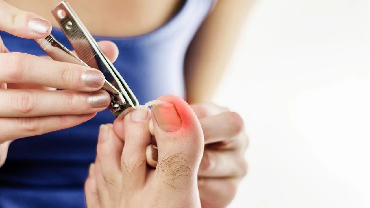 The Real Pain of Ingrown toenails