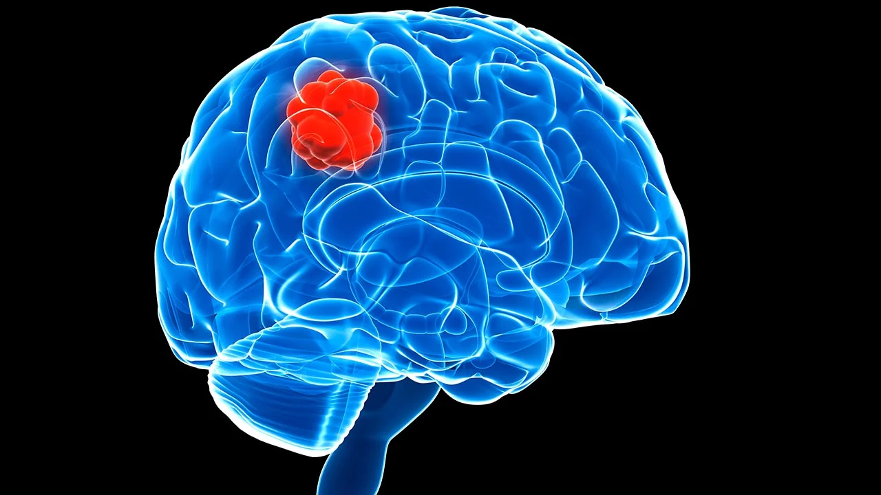 A Promising New Experimental Therapy for Brain Cancer