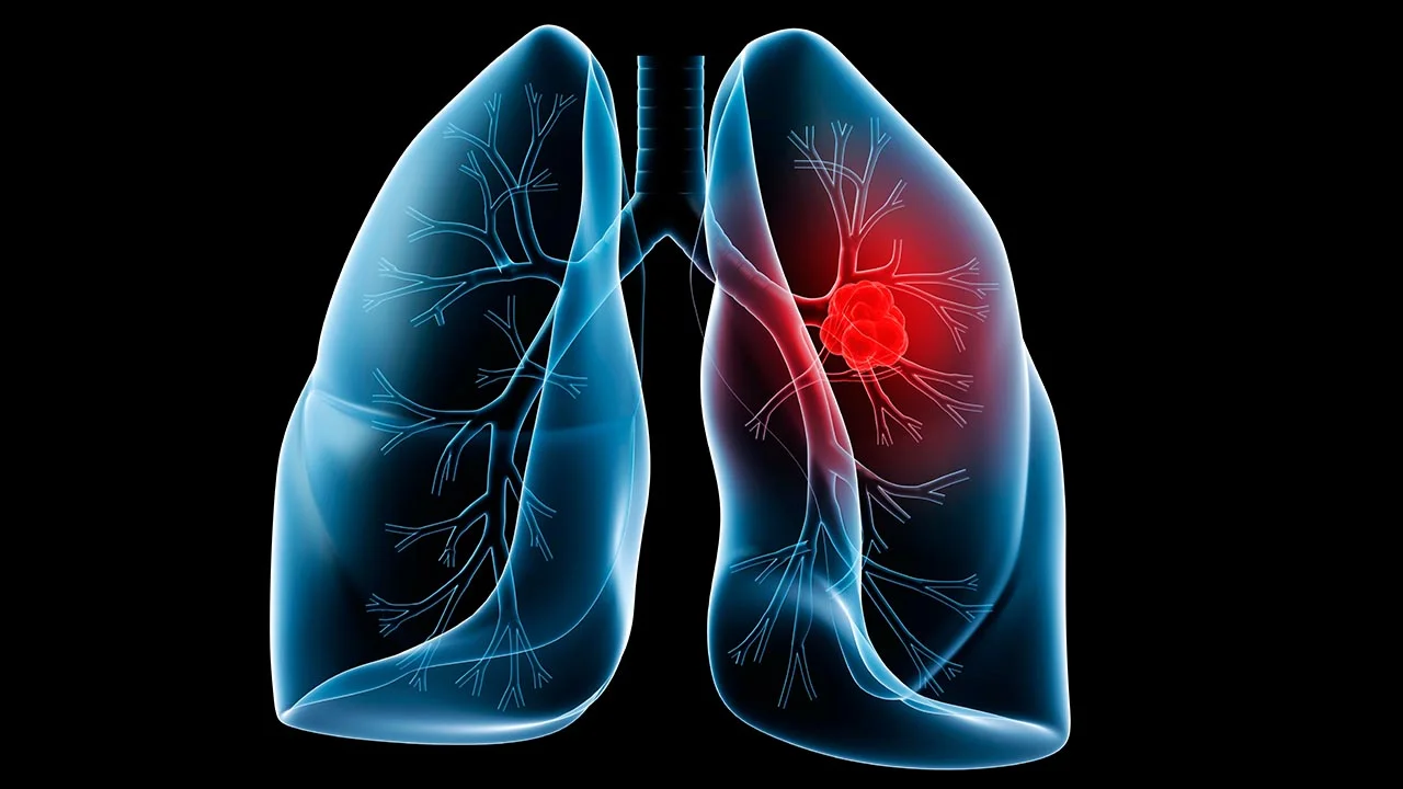 So What Else Causes Lung Cancer?