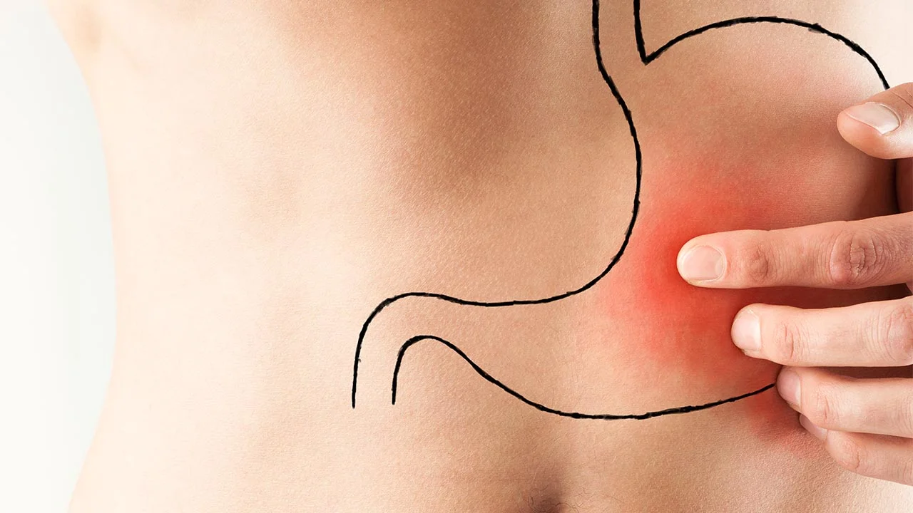 Peptic Ulcers: The Myths and The Management