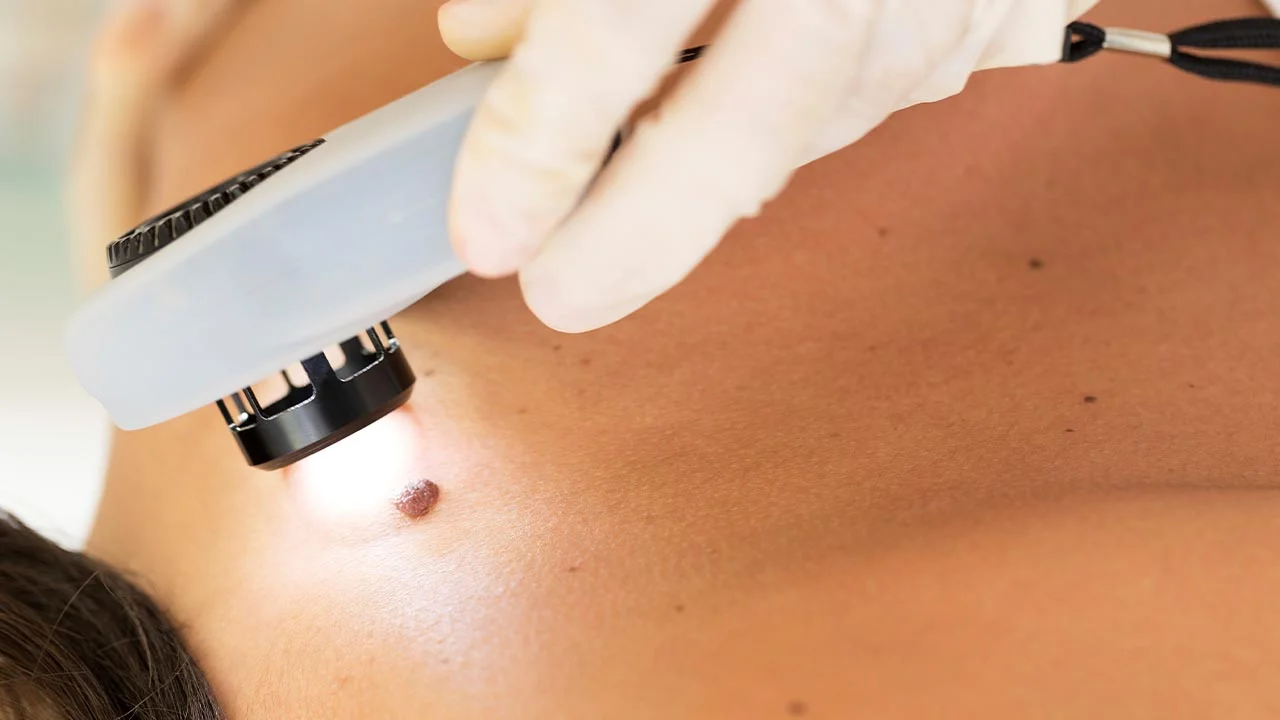 Should You Be Worried About Your Birthmark? 