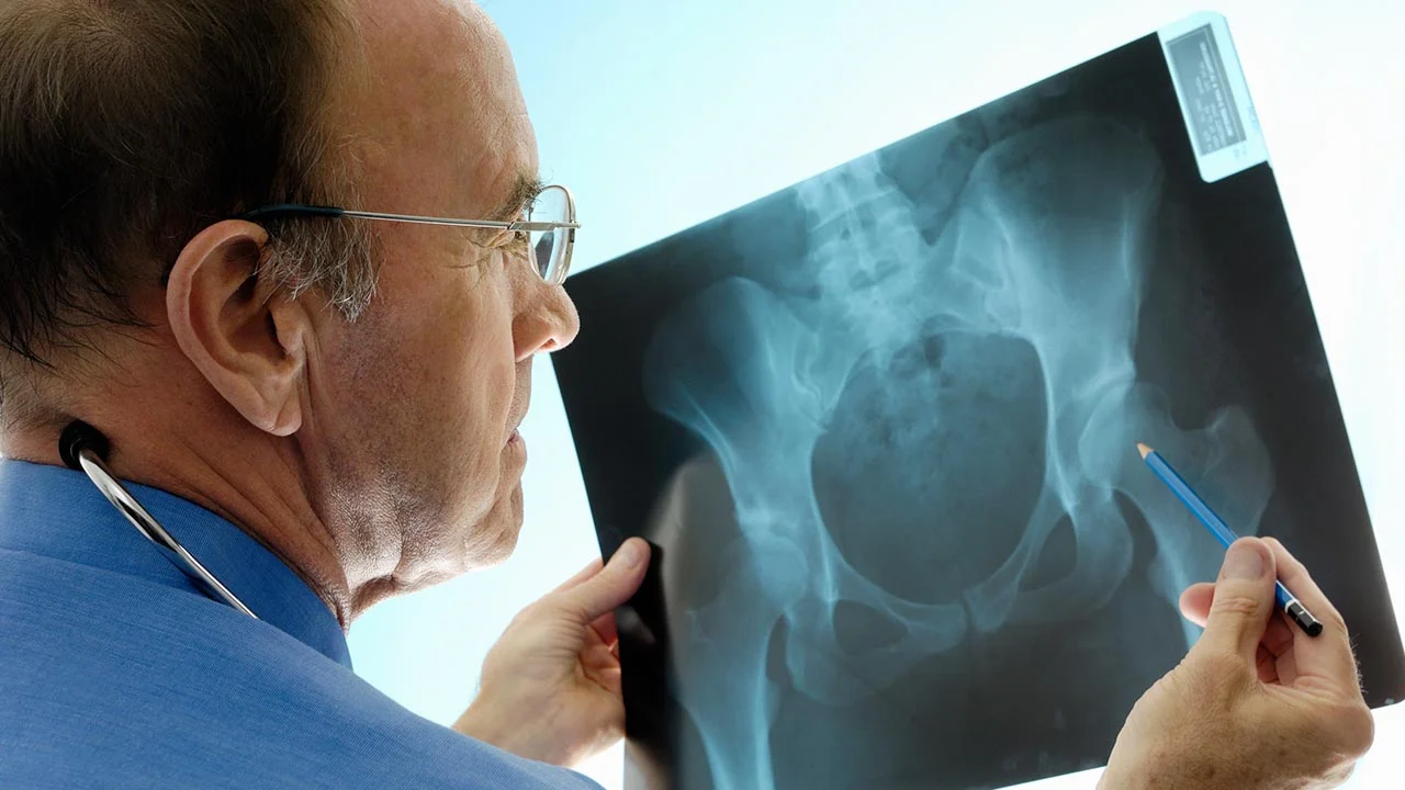 Are You at Risk for Osteoporosis?