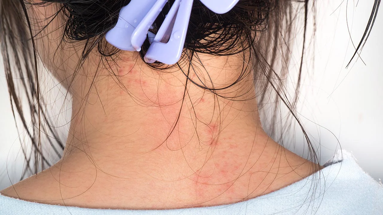 How to Handle Psoriasis