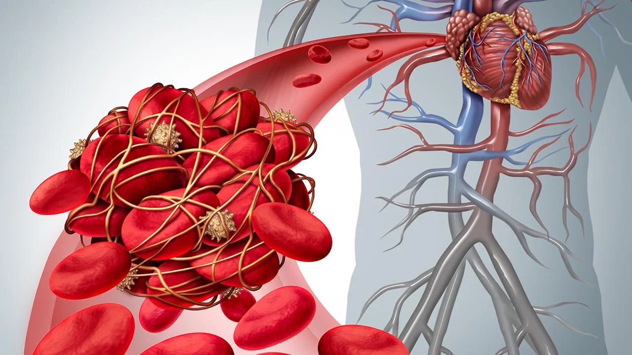 Treating Hardening of the Arteries: Smaller is Better