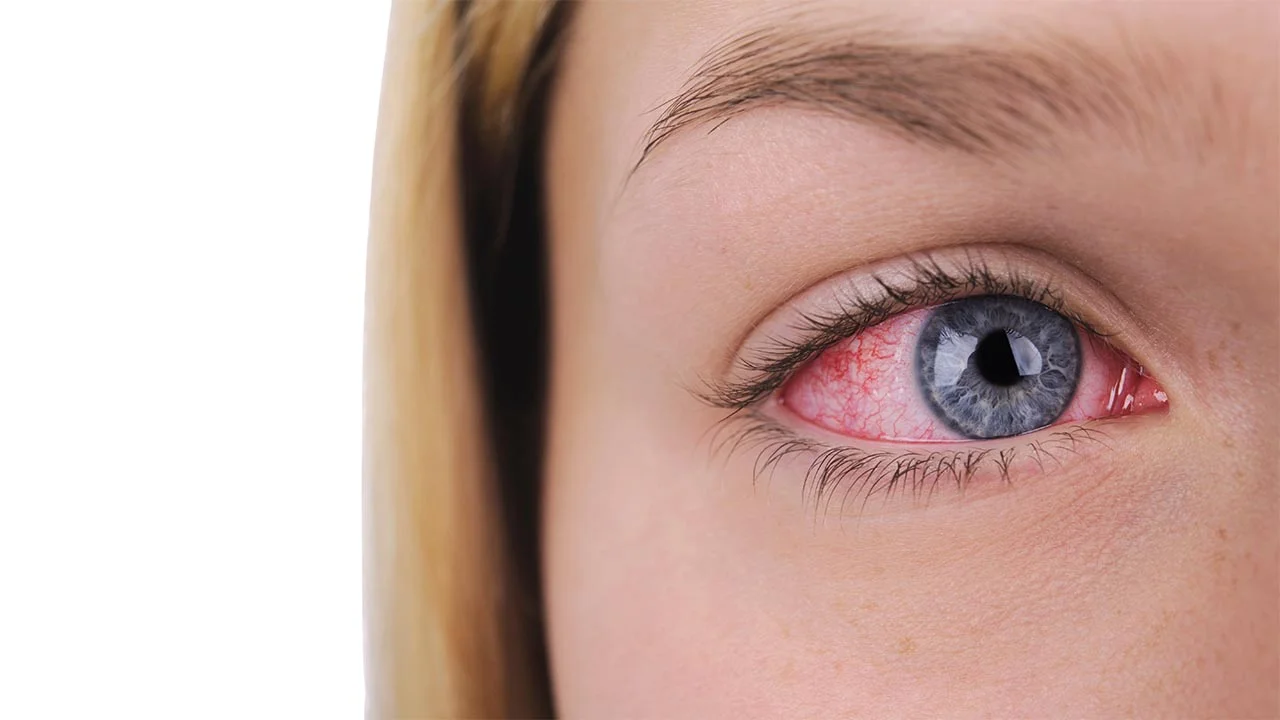 A Closer Look at Uveitis