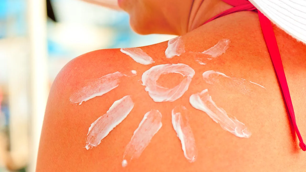 Act fast to soothe a sunburn 