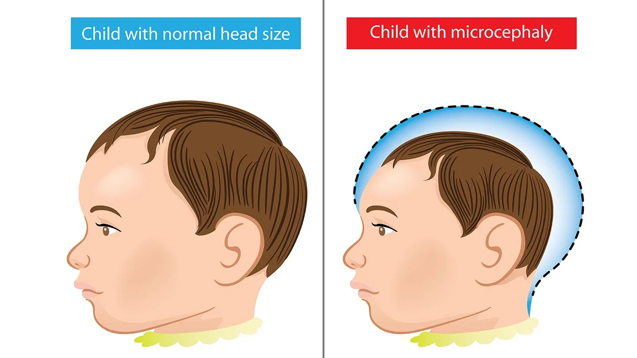 Microcephaly: In The Shadow of Zika