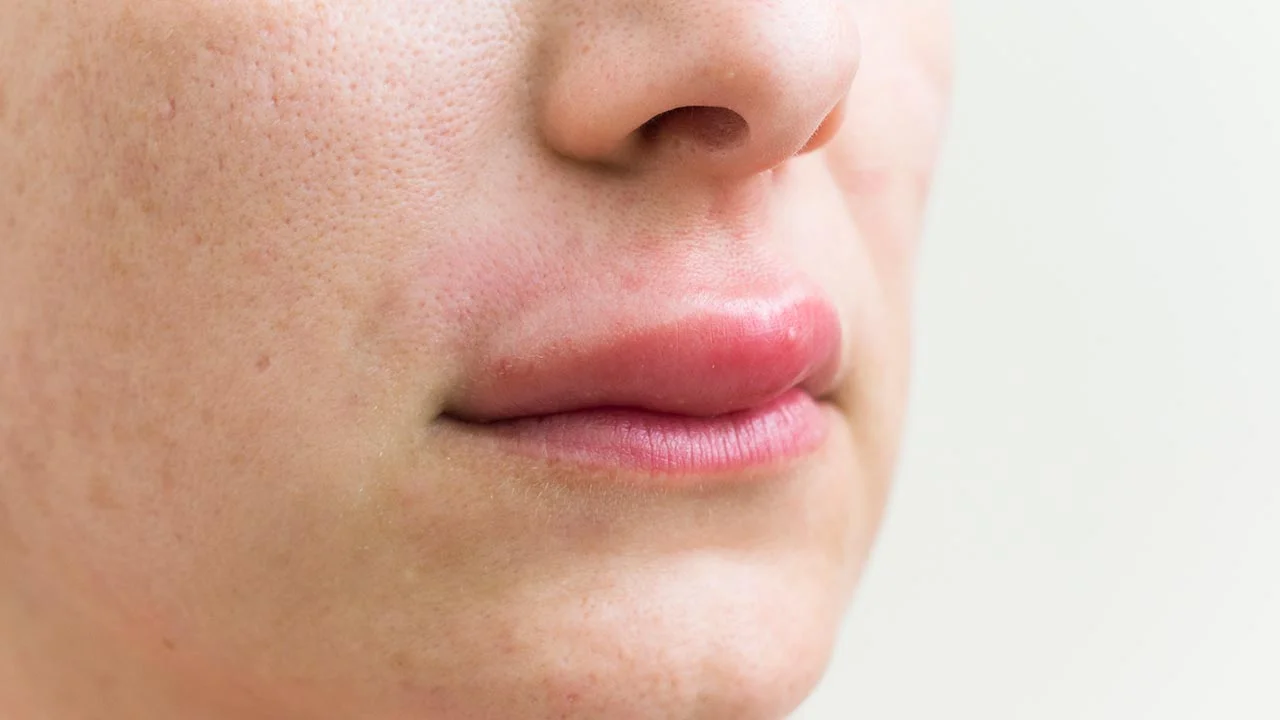 Anaphylaxis: When Every Second Counts