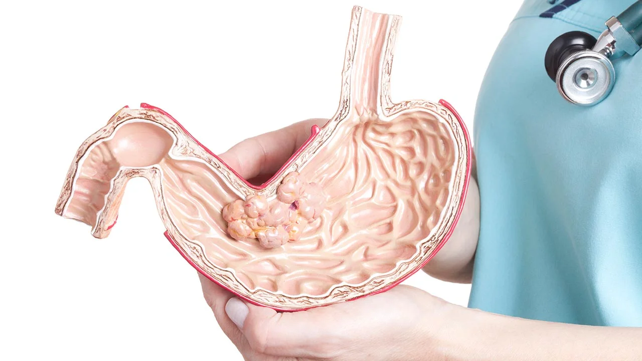 Therapeutic antibody improves outlook for stomach cancer
