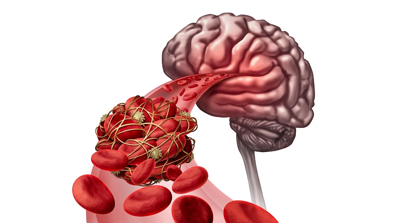 How Cholesterol Fogs Your Brain
