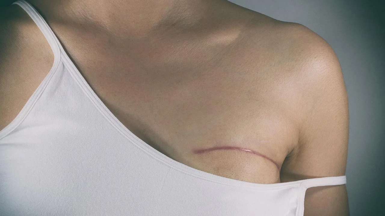 Removal of healthy breast not always advised