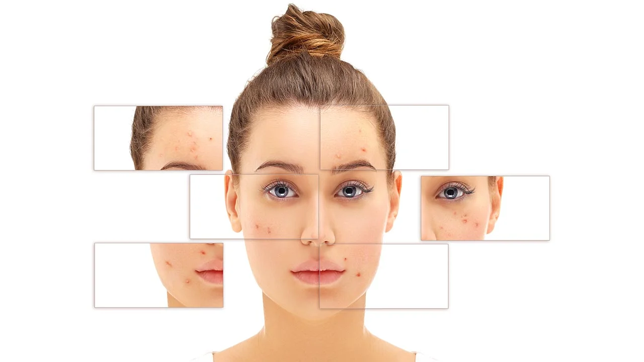 Rosacea & Cold Weather