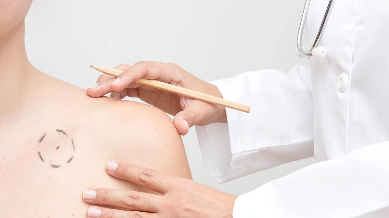 Skin Cancer Signs