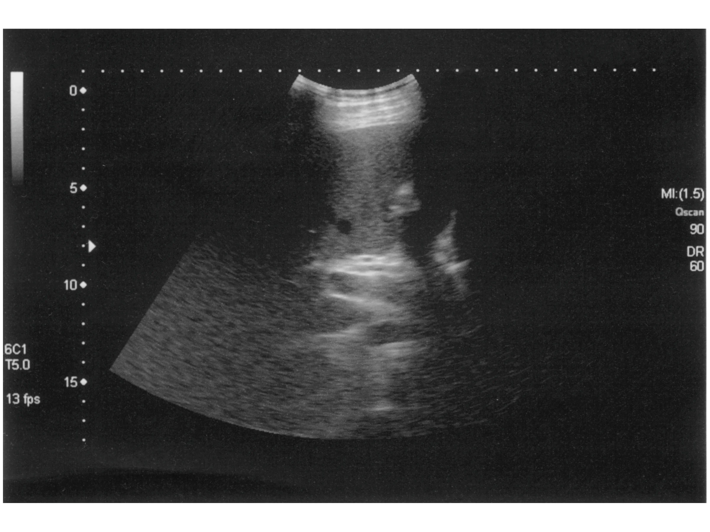 The scoop on gallstones and how to prevent them