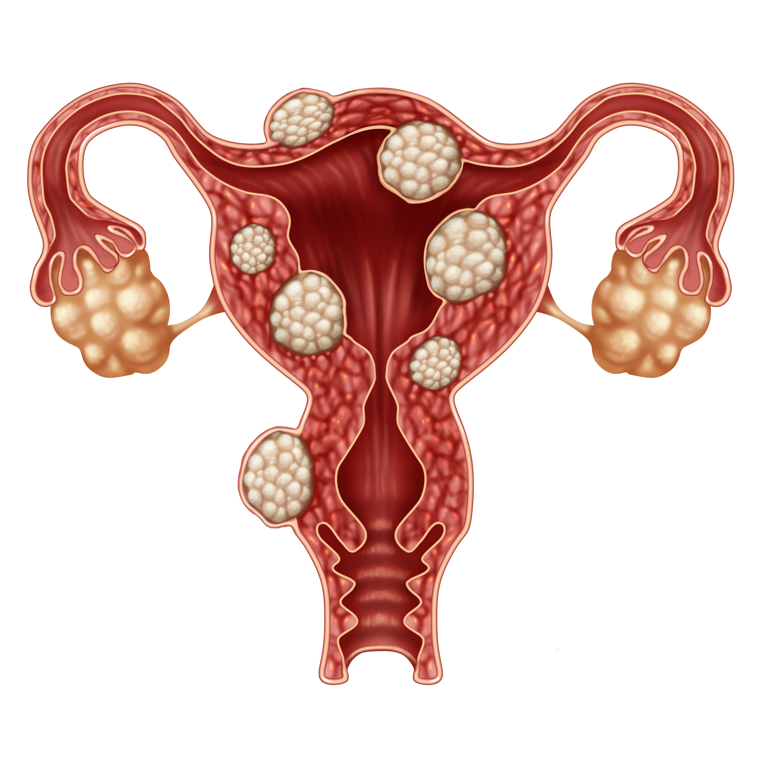 Are uterine fibroids a cause for concern?