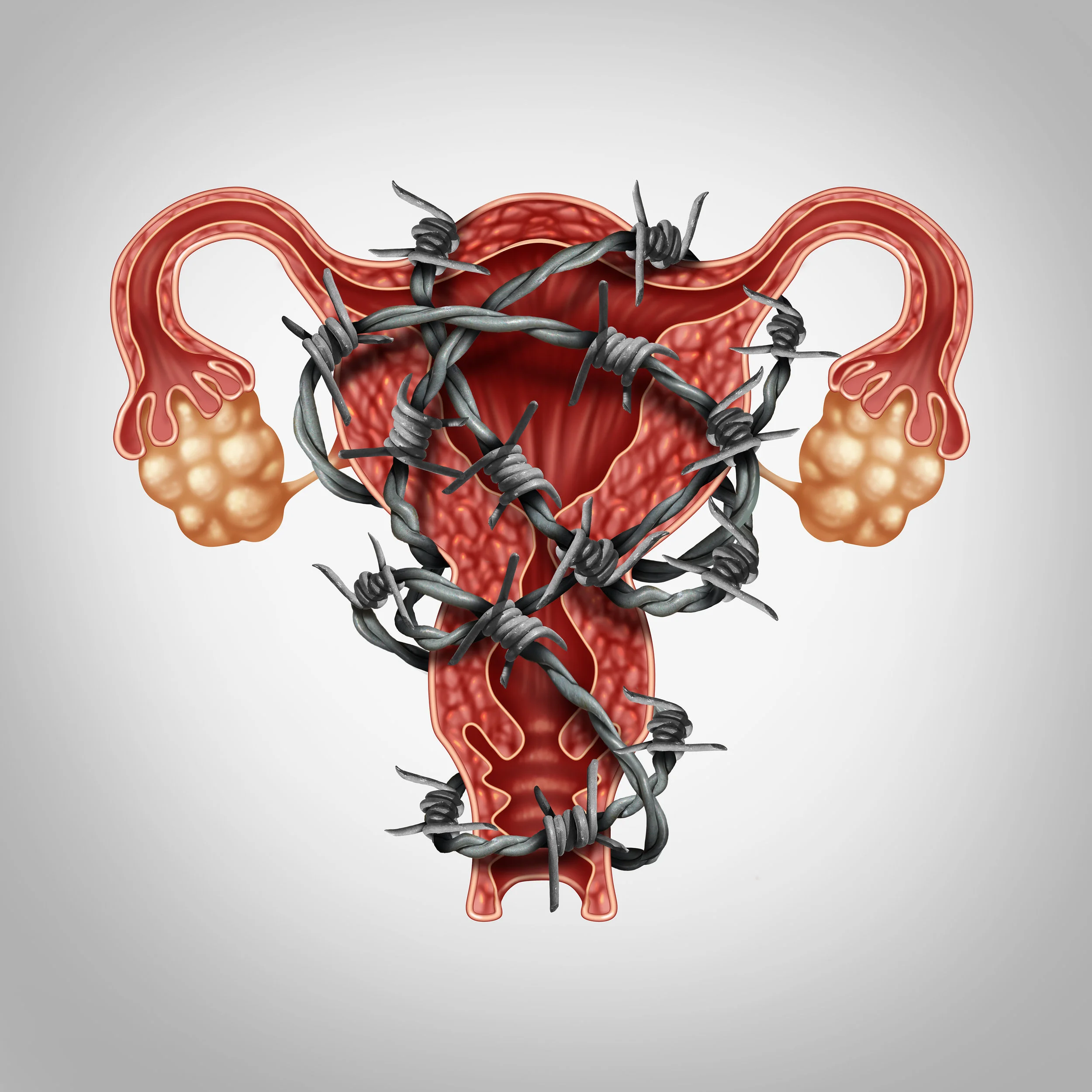 Understanding Endometriosis