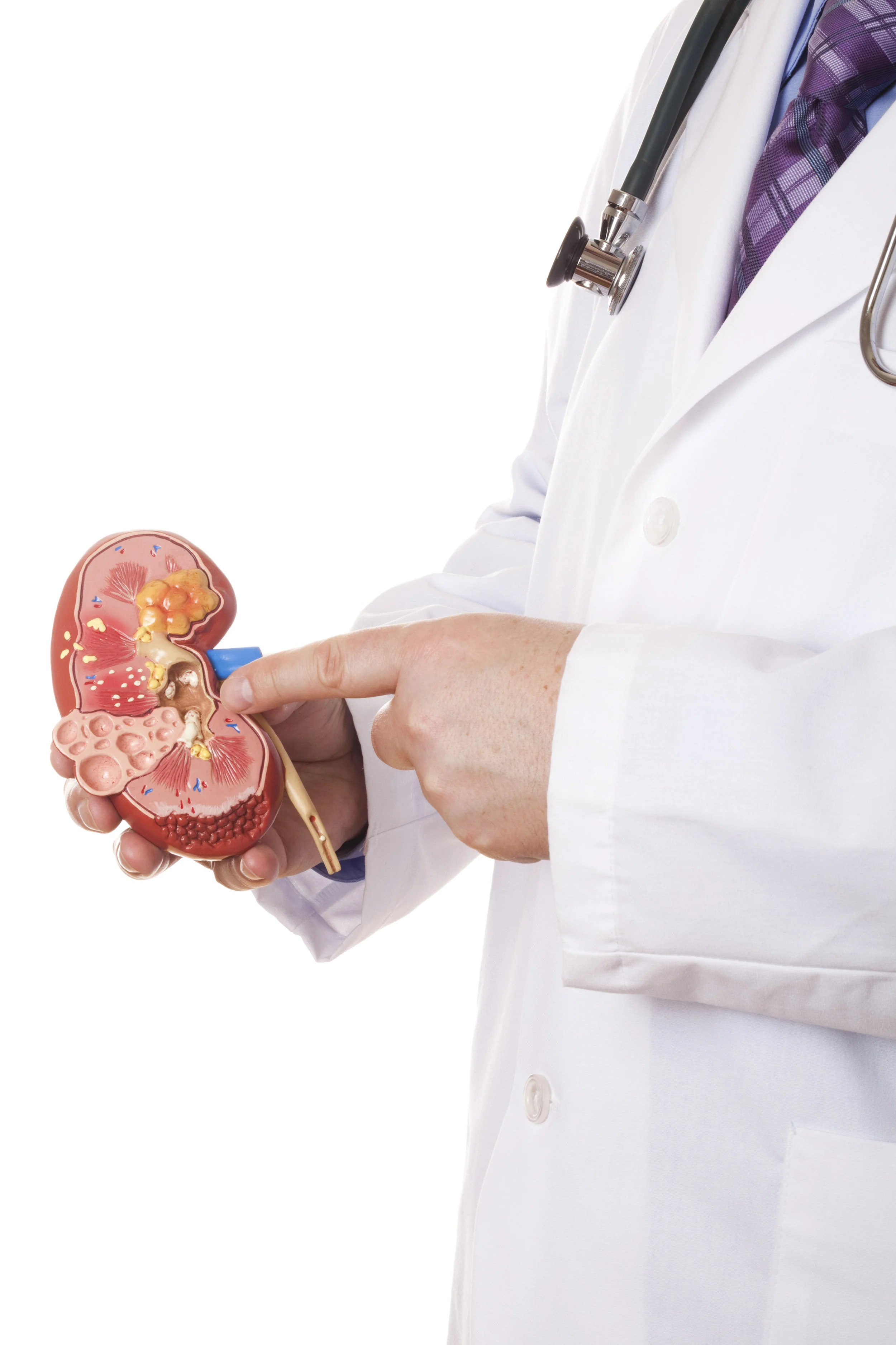 Why kidney stones form and how to prevent them
