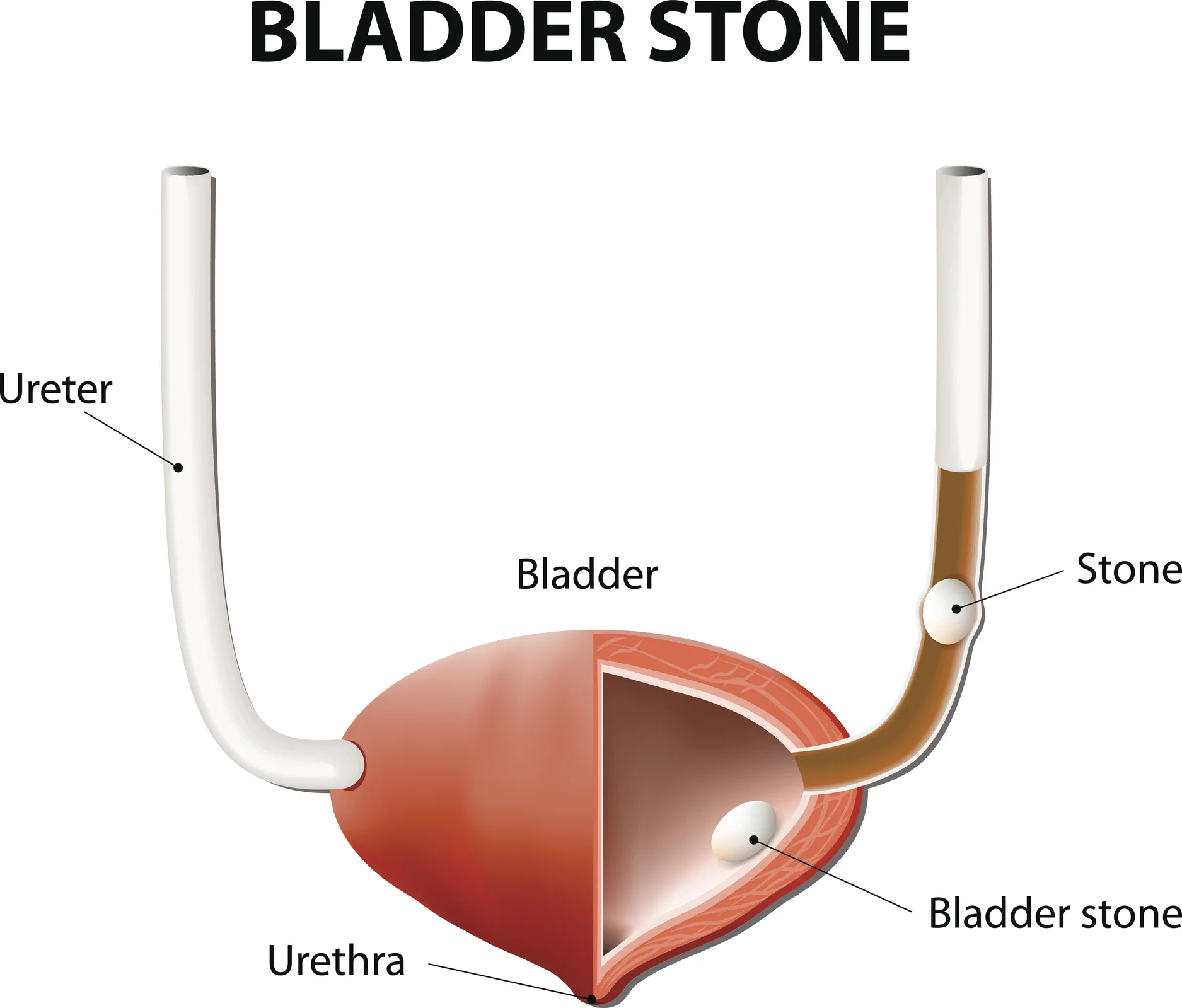 Understanding bladder stones