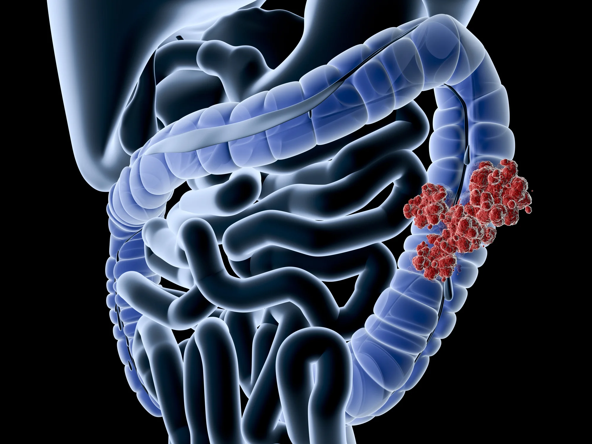 6 ways to cut your risk of colorectal cancer in half