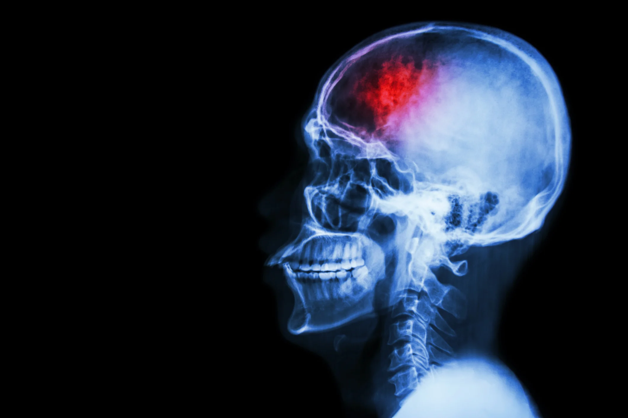 Unexpected signs of a stroke in women