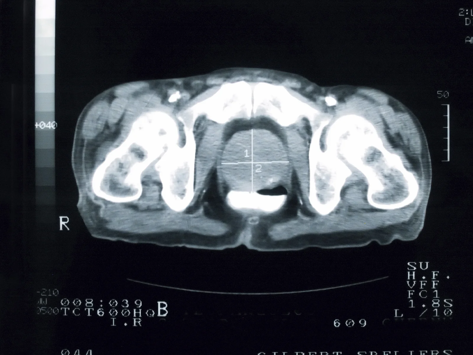 Insufficient sleep associated with increased risk of prostate cancer death in younger men