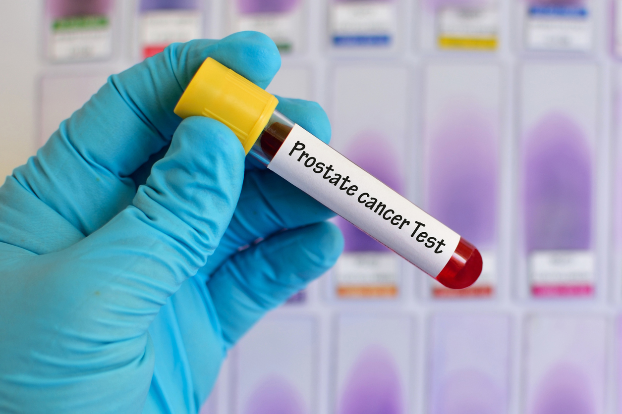 Prostate cancer screening recommendations: What does it mean?