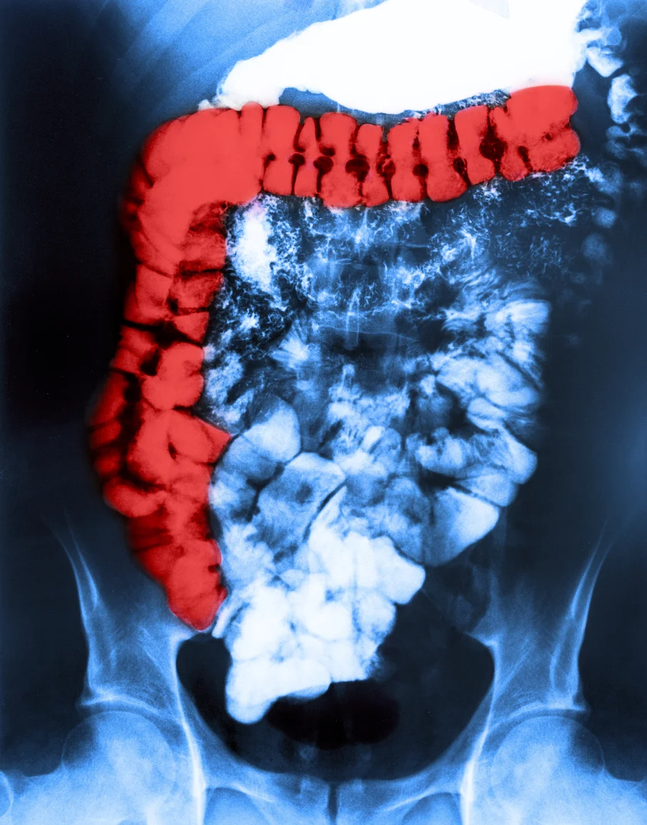 12 steps to relieve IBS symptoms naturally