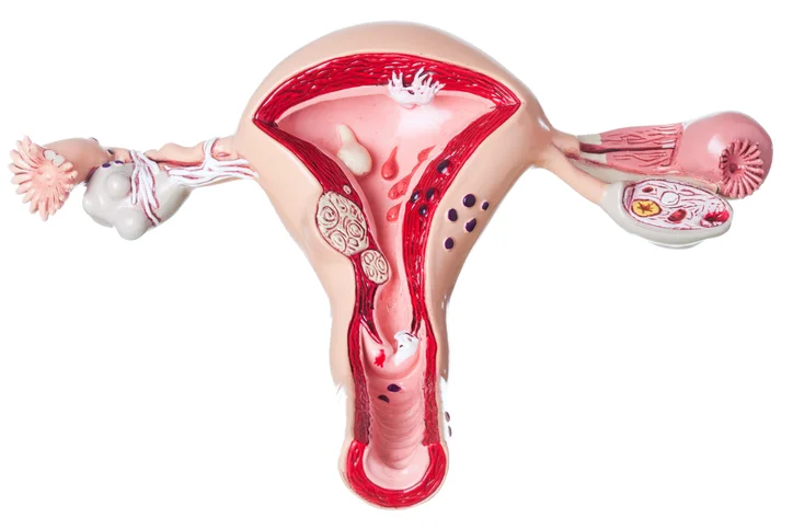 Treatment options for ovarian cancer