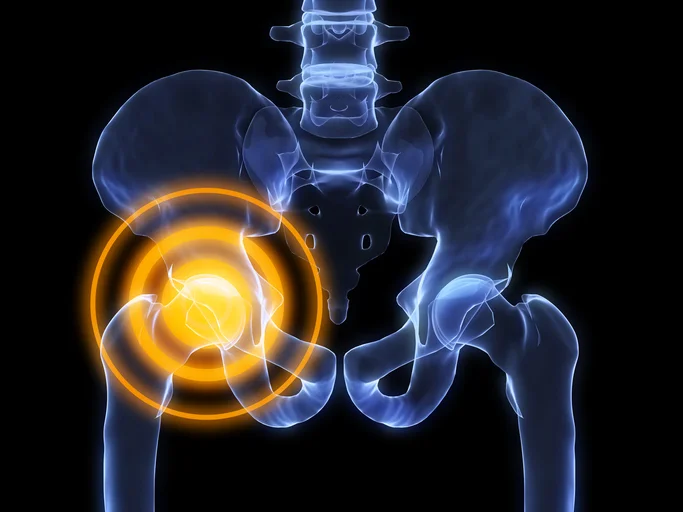 Recognizing 3 signs you may already have osteoporosis