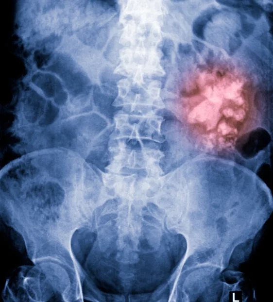 BMI, type 2 diabetes associated with an increased risk of kidney stones
