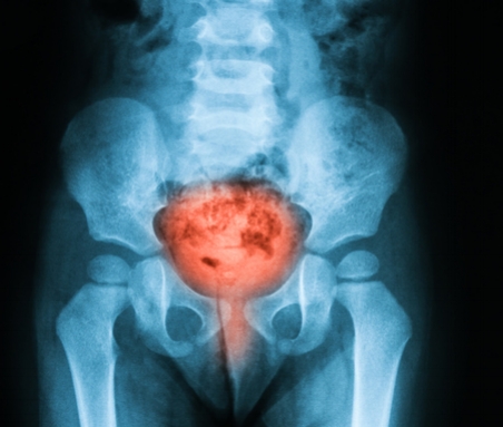 Building a better bladder to reduce incontinence