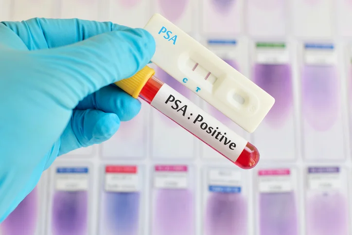 5 facts men should know about PSA
