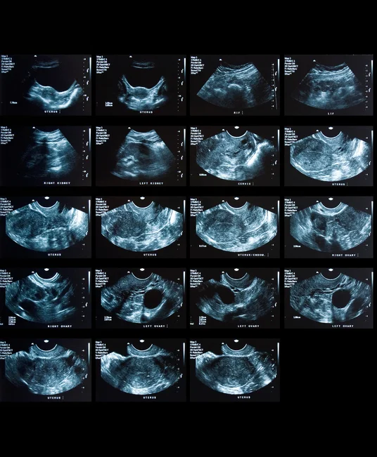 Breastfeeding may reduce risk of endometrial cancer