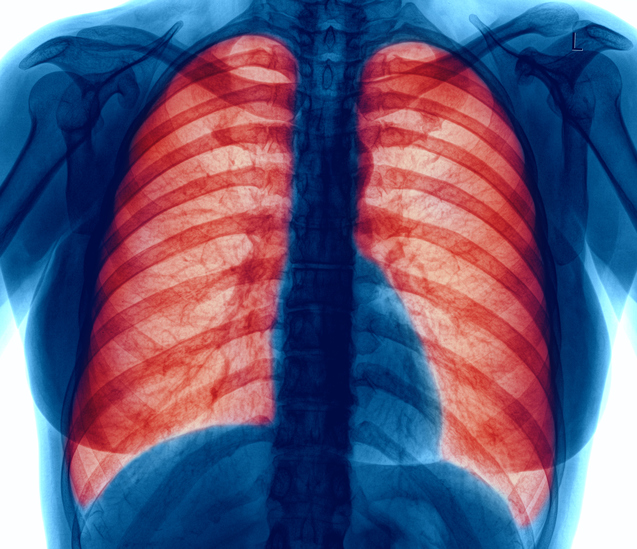 Understanding COPD