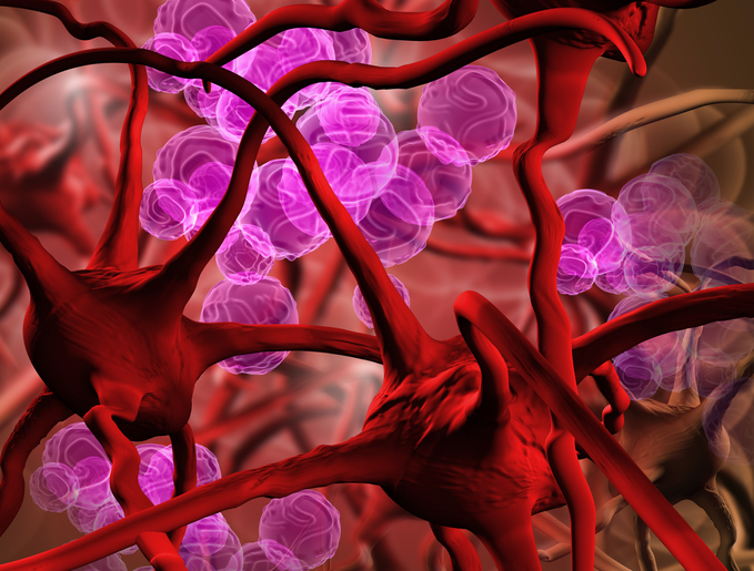 What is iron overload or hemochromatosis?