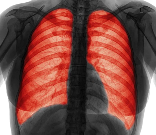 Why your chronic cough could be COPD