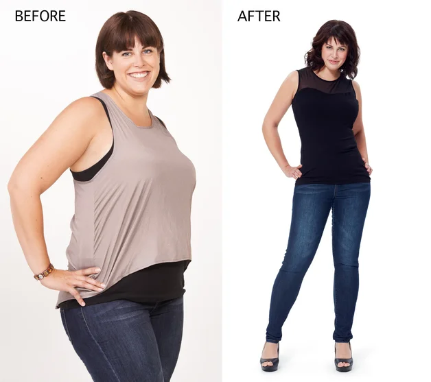 Misconceptions about bariatric weight loss surgery