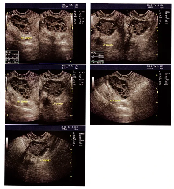 Suspicious symptoms of an ovarian cyst