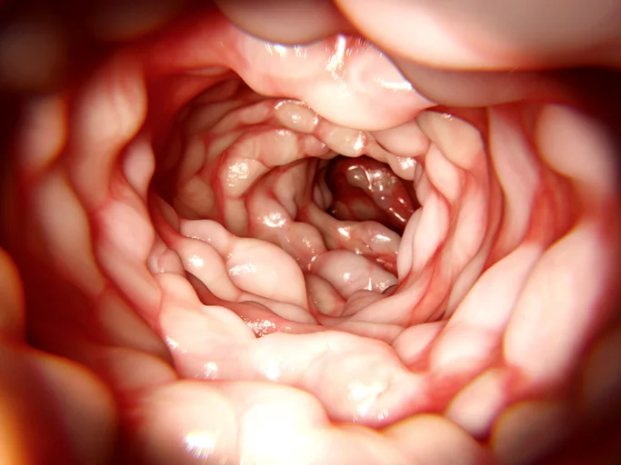 Ulcerative colitis vs Crohn’s disease – similarities and differences