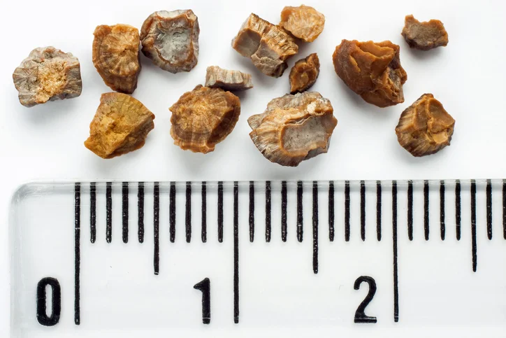 Why citric acid may prevent kidney stones