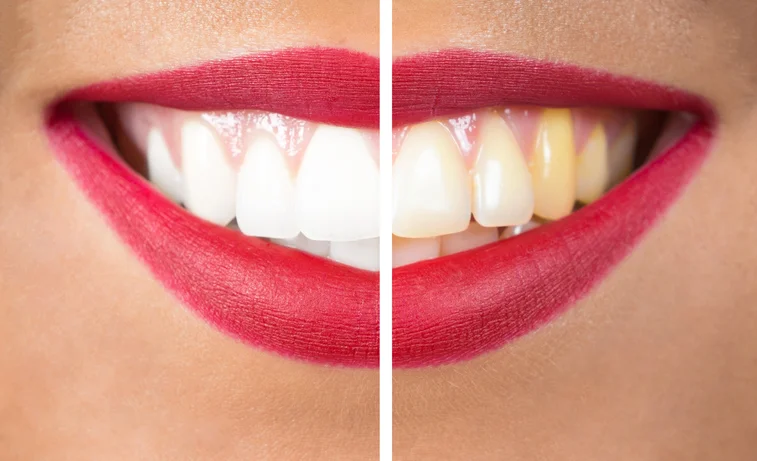 Protect your teeth from periodontal disease