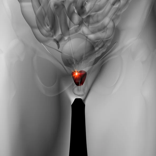 Prostate cancer prognosis improves with exercise