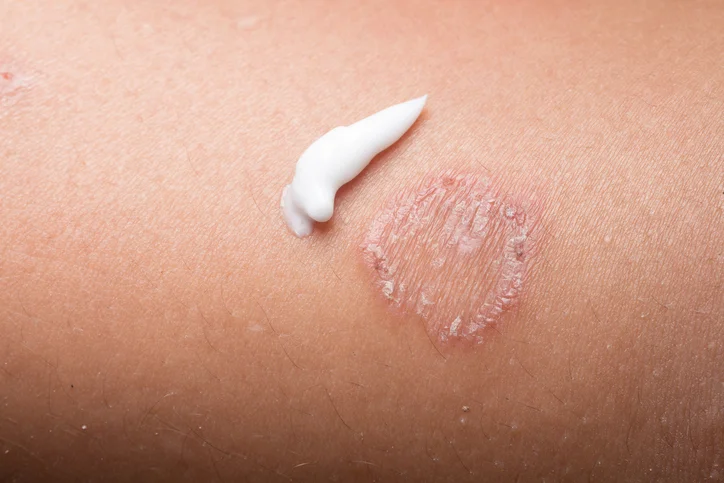 Cellulitis – a common skin infection
