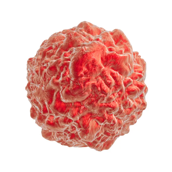 HIFU offers hope for early stage prostate cancer