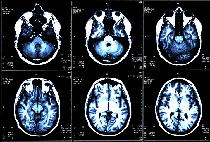 Virus causing mono may raise risk of multiple sclerosis