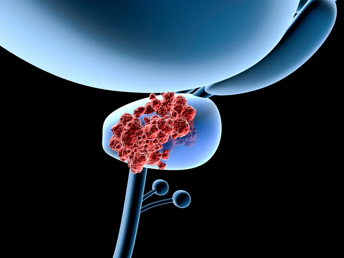 The staging of prostate cancer