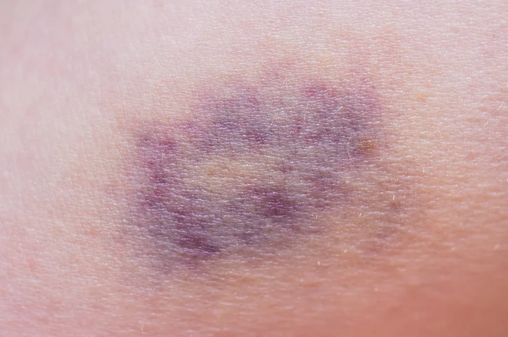 What does it mean if you bruise easily?